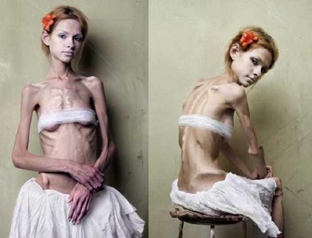 Anoreksija kao posledica
